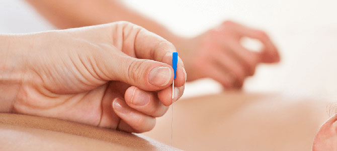 Dry Needle Therapy (Intramuscular Stimulation – IMS)